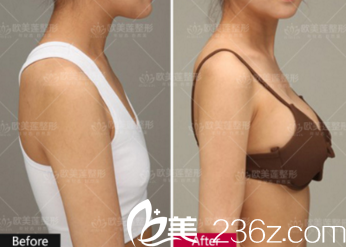 太原歐美蓮姚冰院長隆胸案例 太原歐美蓮姚冰院長隆胸案例