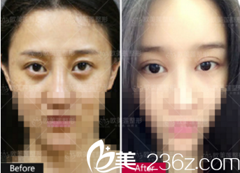 太原歐美蓮姚冰院長雙眼皮失敗修復 太原歐美蓮姚冰院長雙眼皮失敗修復