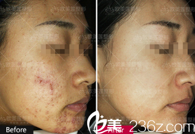 太原歐美蓮整形高燕醫(yī)生祛痘案例 太原歐美蓮整形高燕醫(yī)生祛痘案例