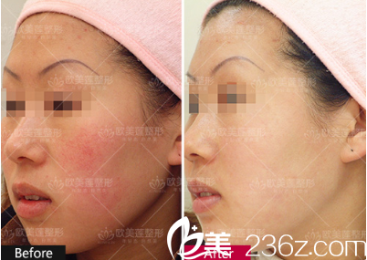 太原歐美蓮整形高燕醫(yī)生激光祛紅血絲真人案例 太原歐美蓮整形高燕醫(yī)生激光祛紅血絲真人案例