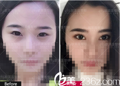 太原歐美蓮高歡利醫(yī)生雙眼皮真實案例 太原歐美蓮高歡利醫(yī)生雙眼皮真實案例