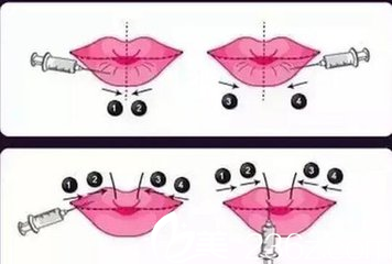 玻尿酸豐唇的過(guò)程