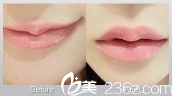 玻尿酸豐唇的前后對(duì)比
