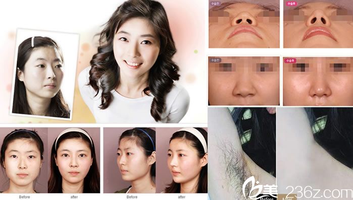 嘉興禾美整形醫(yī)院真人案例 嘉興禾美整形醫(yī)院真人案例