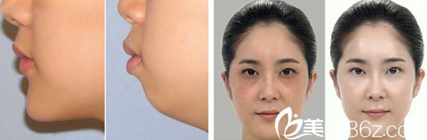 徐高淳院長(zhǎng)微整形美膚案例 徐高淳院長(zhǎng)微整形美膚案例