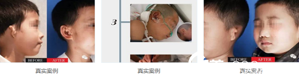 康春雨小耳再造真實(shí)案例 康春雨小耳再造真實(shí)案例