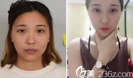 周宇丹院長的分切雙眼皮案例 周宇丹院長的分切雙眼皮案例