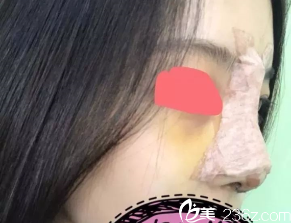 南京維多利亞隆鼻開眼角術(shù)后3天