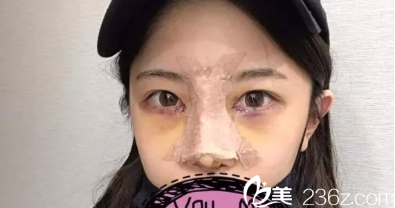 隆鼻開眼角術(shù)后5天