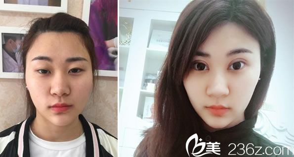 趙學(xué)燕醫(yī)生做雙眼皮怎么樣 趙學(xué)燕醫(yī)生做雙眼皮怎么樣