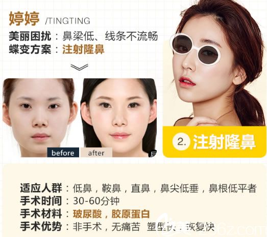 禾美注射隆鼻手術(shù)案例