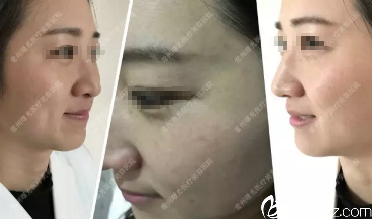 術前臉上干紋紅血絲 術前臉上干紋紅血絲