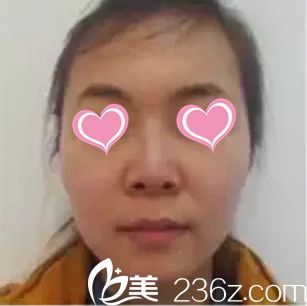 做鼻綜合整形術(shù)前的樣子 做鼻綜合整形術(shù)前的樣子