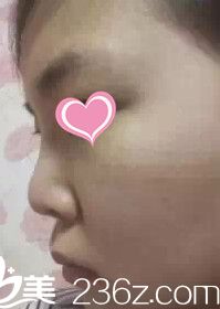 咬肌發(fā)達(dá) 咬肌發(fā)達(dá)