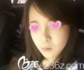 天生大頭鼻在做完鼻綜合整形后呈現(xiàn)驚艷效果