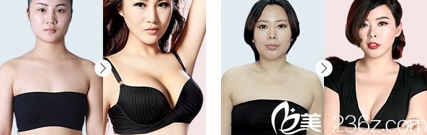 盛飛醫(yī)生隆胸手術案例