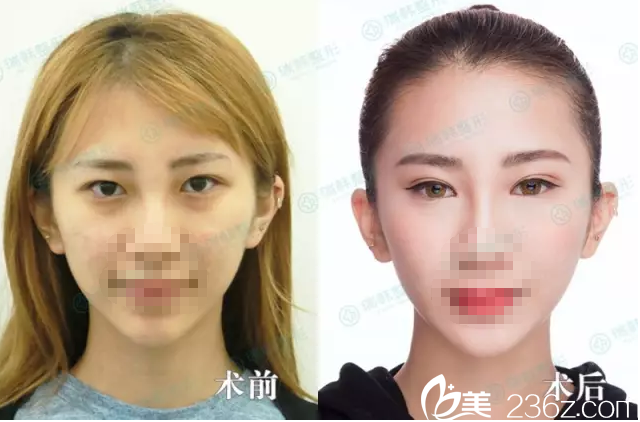 海南瑞韓雙眼皮案例