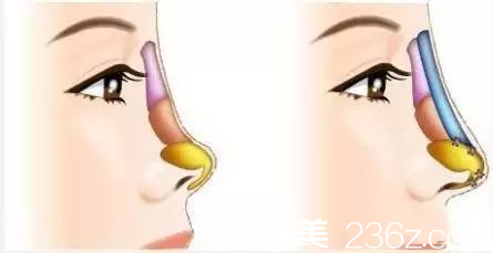 隆鼻只是簡(jiǎn)單的墊高鼻子？