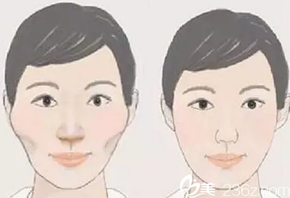 做顴骨整形哪家醫(yī)院好？北京做顴骨整形好的醫(yī)院