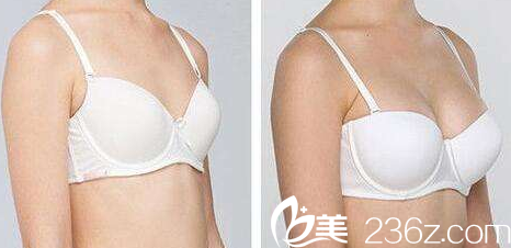 運(yùn)城麗都整形王新?tīng)N隆胸案例展示