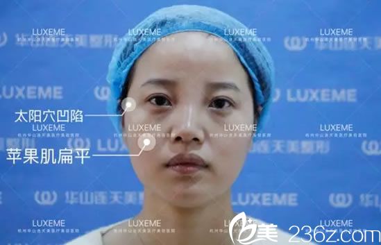 注射玻尿酸和瘦臉前的照片 注射玻尿酸和瘦臉前的照片