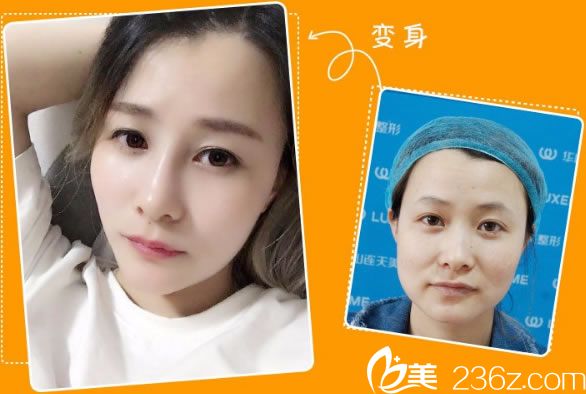 李大琦醫(yī)生注射瘦臉案例 李大琦醫(yī)生注射瘦臉案例