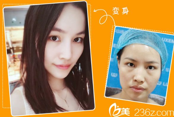 李大琦醫(yī)生注射玻尿酸的案例 李大琦醫(yī)生注射玻尿酸的案例