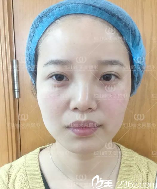 注射玻尿酸即刻效果圖 注射玻尿酸即刻效果圖