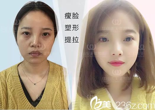 注射瘦臉前后效果對比照 注射瘦臉前后效果對比照