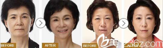 張水金面部除皺前后對比效果圖