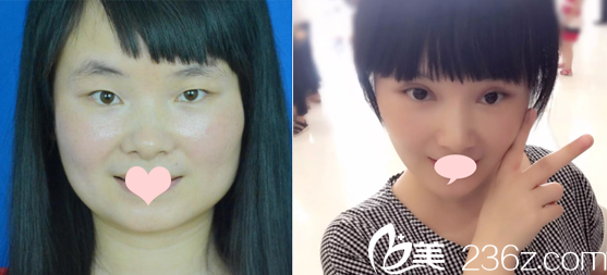 南寧夢想唐超雙眼皮案例對(duì)比圖 南寧夢想唐超雙眼皮案例對(duì)比圖