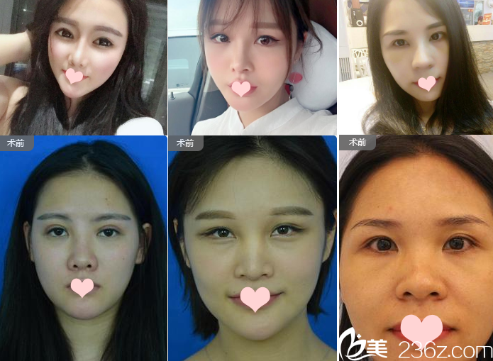 南寧夢想唐超鼻綜合隆鼻案例組圖 南寧夢想唐超鼻綜合隆鼻案例組圖