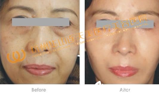 RF除皺緊膚技術(shù)案例效果