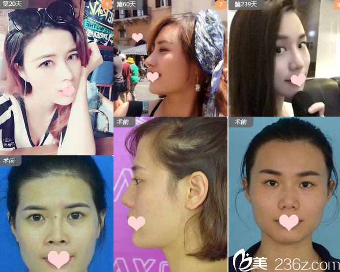 南寧夢想整形醫(yī)生周維志鼻綜合隆鼻案例組圖 南寧夢想整形醫(yī)生周維志鼻綜合隆鼻案例組圖