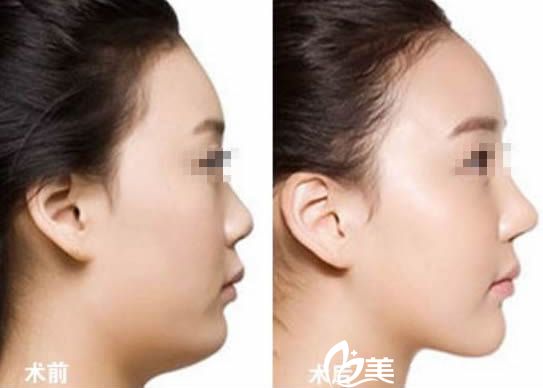 崔相哲醫(yī)生注射隆鼻案例圖