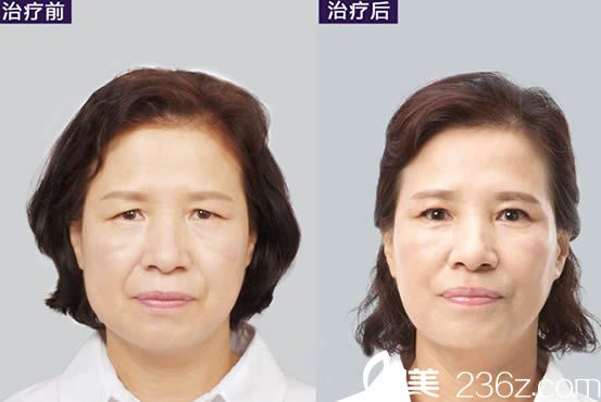 崔相哲面部除皺提拉前后對比效果