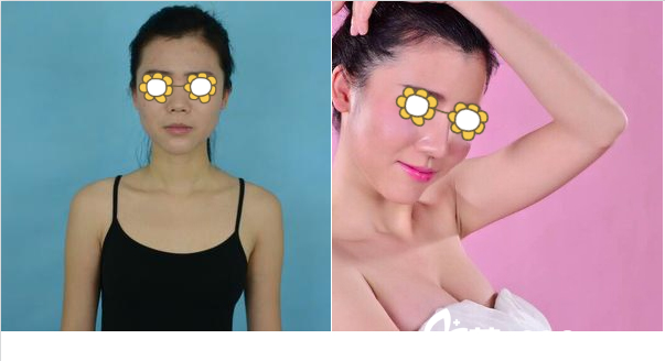 南寧夢想黎洪棉自體脂肪隆胸案例 南寧夢想黎洪棉自體脂肪隆胸案例