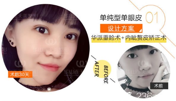 單純切開雙眼皮案例圖 單純切開雙眼皮案例圖