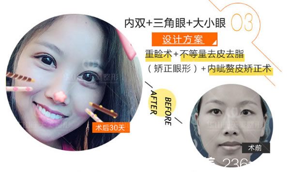 雙眼皮和開眼角案例效果 雙眼皮和開眼角案例效果