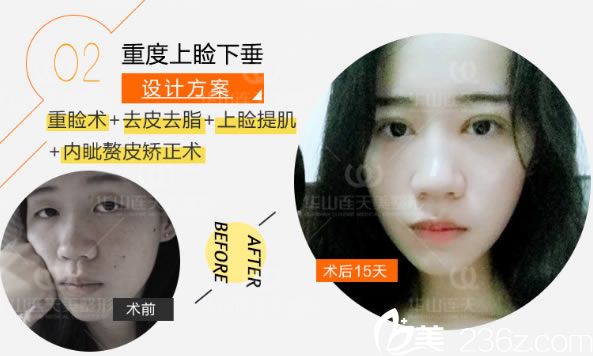 上瞼下垂矯正手術(shù)案例圖 上瞼下垂矯正手術(shù)案例圖