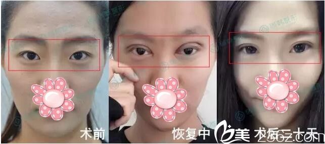 雙眼皮術(shù)前到術(shù)后改變 雙眼皮術(shù)前到術(shù)后改變