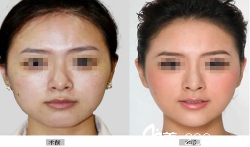 辜麗萍醫(yī)生注射瘦臉對(duì)比案例圖 辜麗萍醫(yī)生注射瘦臉對(duì)比案例圖