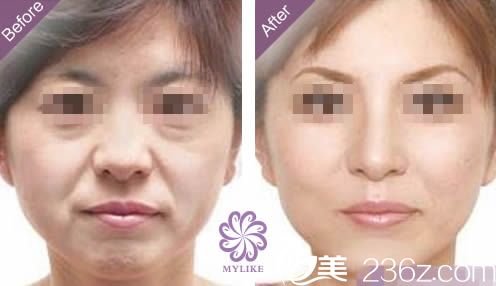 辜麗萍主任面部除皺案例圖 辜麗萍主任面部除皺案例圖