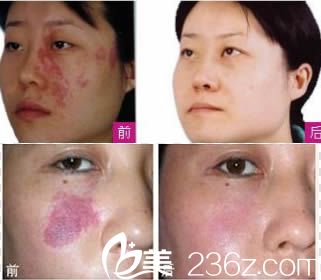 莊婉瑜主任激光祛胎記對比圖 莊婉瑜主任激光祛胎記對比圖