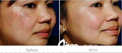 莊婉瑜激光祛斑案例 莊婉瑜激光祛斑案例