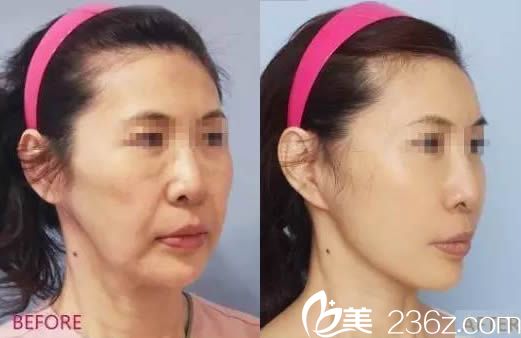 路世敏面部線雕案例圖