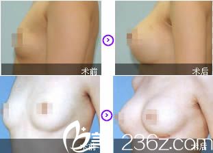 盛宗順假體隆胸案例 盛宗順假體隆胸案例