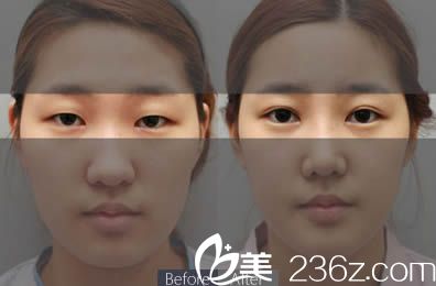 盛宗順醫(yī)生雙眼皮前后對比圖 盛宗順醫(yī)生雙眼皮前后對比圖