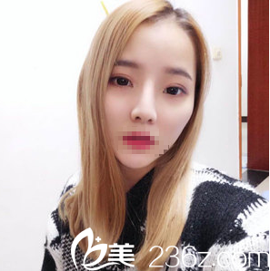 成都藝星周順波隆鼻怎么樣？肋軟骨隆鼻術(shù)后3個(gè)月真實(shí)恢復(fù)效果分享