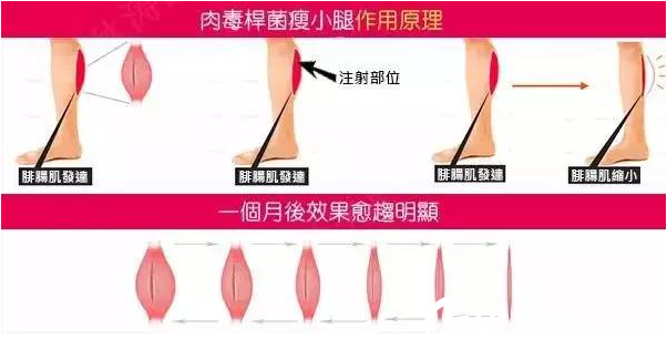 瘦腿注射原理作用原理